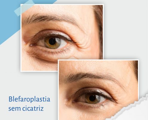 Blefaroplastia sem cicatriz